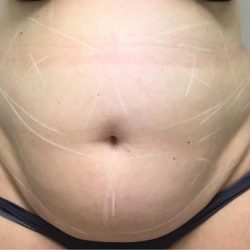 TruSculpt ID Before & After Patient #1567